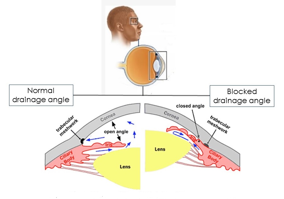 Causes of glaucoma.